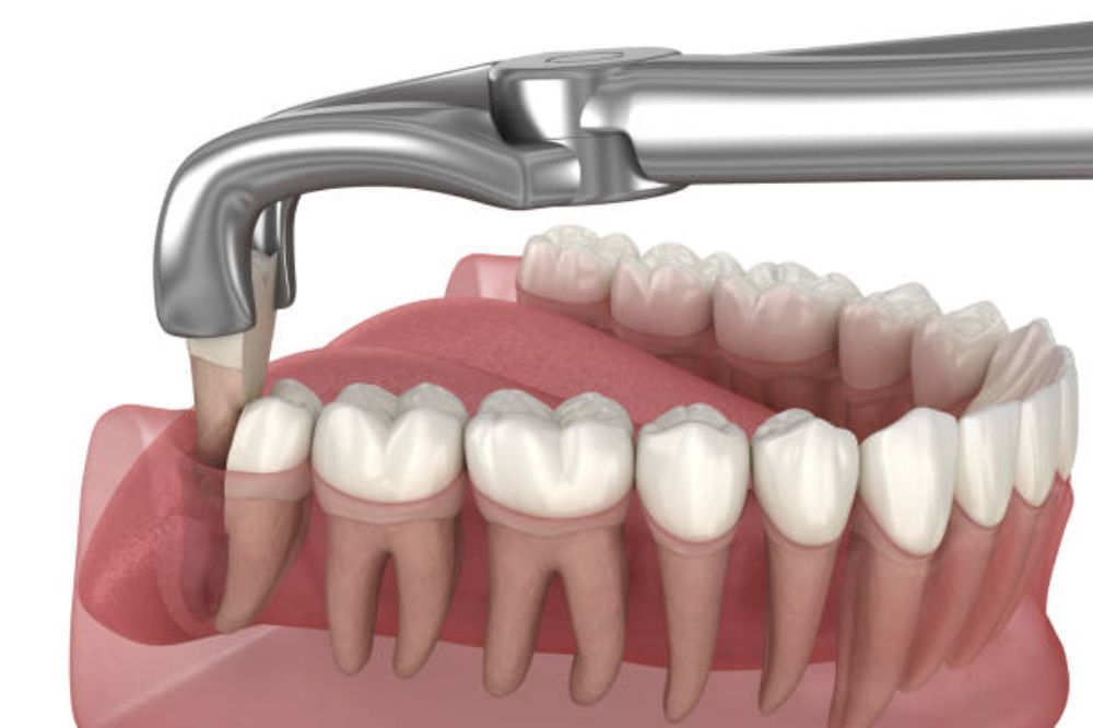 can-you-remove-all-four-wisdom-teeth-at-once