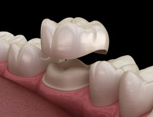 how to take care of new dental crown