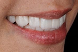 teeth whitening side effects