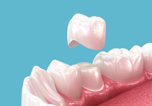 dental crowns in sw calgary