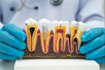 root canal treatment in calgary
