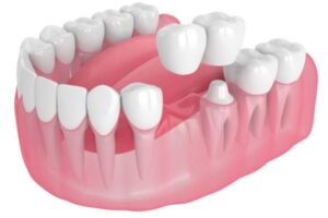 why-is-my-crowned-tooth-hurting-common-reasons-for-pain-under-a-dental-cap